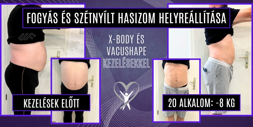 Szétnyílt hasizom helyreállítása és fogyás x-body és vacushape kezeléssel