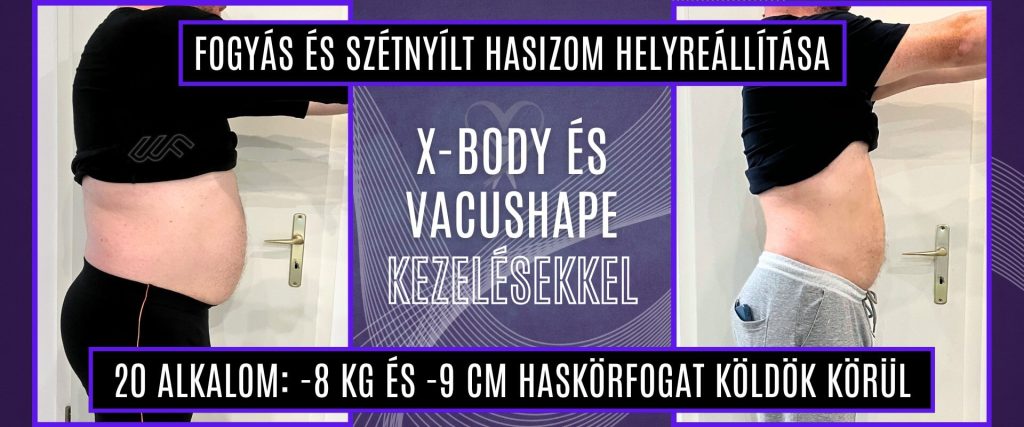 Szétnyílt hasizom helyreállítása és fogyás x-body és vacushape kezeléssel